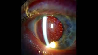 Silicone Oil in an Aphakic eye [upl. by Geithner639]