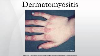 Dermatomyositis [upl. by Resiak911]