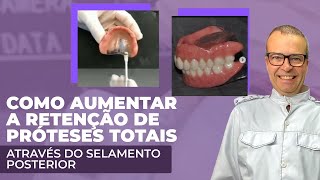 selamento posterior em prótese total [upl. by Atnoek]