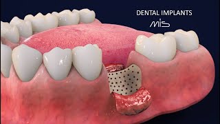 How to Perform Dental Implants by MIS Tutorial 3D Dental Animation [upl. by Haral]