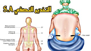 التخدير الشوكيالنصفي Spinal Anesthesia [upl. by Amand]