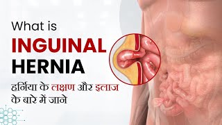 What is Inguinal Hernia Signs amp Symptoms Surgery Treatment amp Recovery in Hindi अंडकोष में हर्निया [upl. by Feodor]