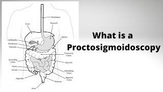 What is a Proctosigmoidoscopy [upl. by Lerud]