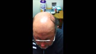 Integrating Scalp Acupuncture and Speech Therapy for Treatment of Dysarthria with GREAT result [upl. by Hsejar]