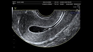Procedimiento Histerosonografía [upl. by Anglim515]