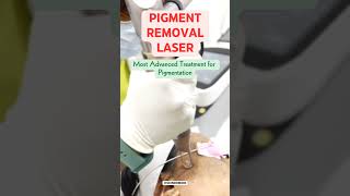 Pigment Removal Laser PICO [upl. by Cowey]