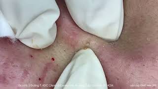 Big Cystic Acne Blackheads Extraction Blackheads amp Milia Whiteheads Removal Pimple Popping [upl. by Eihtak656]