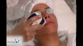 MeDioStar NeXT  Training video for hair removal face from Asclepion [upl. by Mraz368]