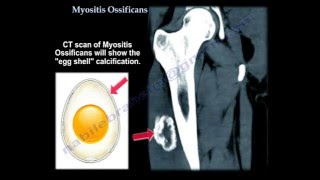 Myositis Ossificans  Everything You Need To Know  Dr Nabil Ebraheim [upl. by Slaughter]