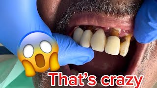 Crwons and teeth removing 😱CRAZY video 🤢🤢 [upl. by Zelde]