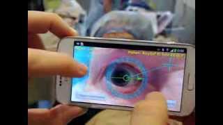 TOREASY  first noncontact Smartphone enabled eye marking for toric IOLs [upl. by Enirac]