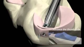 Arthroscopic Meniscus Repair [upl. by Yelekalb]