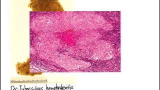 Lymphadenopathy TB vs Lymphoma [upl. by Ybbob]