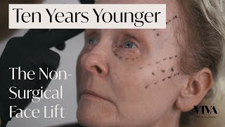 NonSurgical Facelift with Dermal Fillers ❇️ Look 10 Years Younger without Surgery [upl. by Doralynne865]