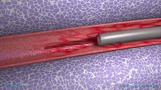 Peripheral IV Phlebitis Animation [upl. by Allistir]