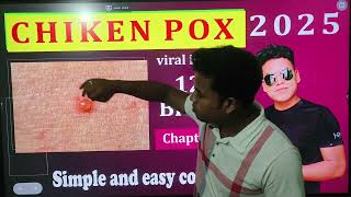 chicken pox health and disease for NEET and board exam [upl. by Moody994]