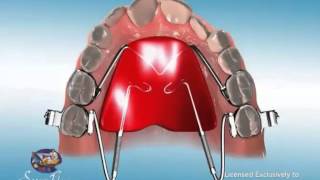 ES Ortho and Distal Jet Appliance [upl. by Amr]