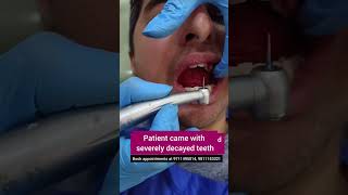 Smile Makeover with CAD CAM Zirconia crowns Dr Srishti Bhatia teethdecay dentist [upl. by Adnylem957]