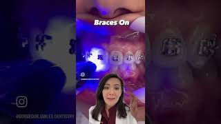 How can Braces straighten teeth [upl. by Kelton]