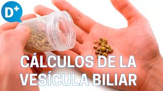 Causas y síntomas de los cálculos de la vesícula biliar [upl. by Zora84]