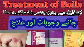 Boils Treatment  Boils kiun nikltay hn oar unka elaj  Kin afrad main boils ziyada nikaltay hn [upl. by Veejar936]