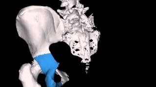 Acetabular fracture demo [upl. by De Witt]