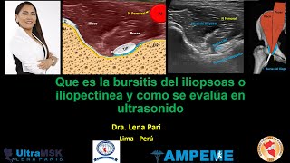 Como identificar la bursitis del Iliopsoas o iliopectínea en ultrasonido Dra Lena Pari [upl. by Amer]