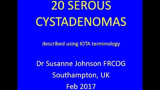 serous cystadenomas YouTube Feb 2017 [upl. by Durwin]