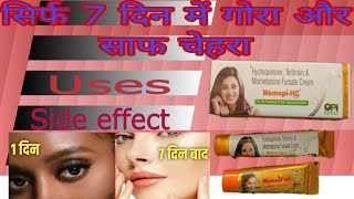 MemopiHC Cream Uses In Hindi  Hydroquinone Tretinoin Mometasone Furoate Cream Benefits amp Side E [upl. by Finstad]