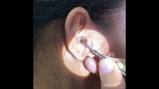 Removing Womans Giant Earwax Using An Ear Curette [upl. by Atniuqal]