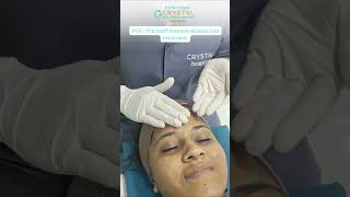 pilling treatment skincare hairlosstreatment rajkot trendingreels top reelsindia pilling [upl. by Hogle]