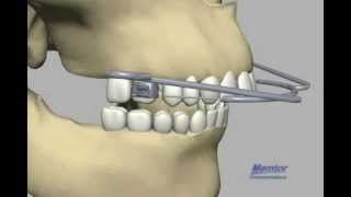 Head Gearcorrect overjet [upl. by Forrester]