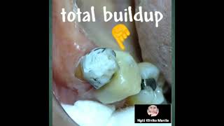 splint under cosmetic total buildup premolar tooth mobile amp deep caried enamel shell almost ruined [upl. by Melquist963]