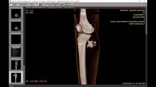 Complicated osteochondroma [upl. by Neelehtak]