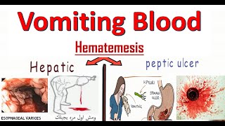 Hematemesis in Emergency تعمل ايه مع حالات ترجيع الدم فى الاستقبال والطوارئ [upl. by Hepsoj953]