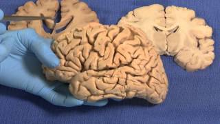 Limbic Neuroanatomy Video Lab  Brain Dissections [upl. by Rudin]