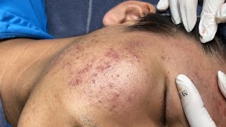 ACNE TREATMENT VU QUYNH MI Acne On Boys Chin 2024 [upl. by Aseena]