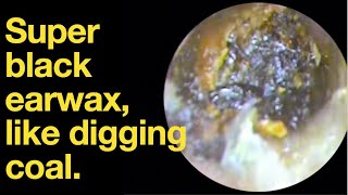 Super black earwax like digging coal ear wax removal  ear cleaning  ASMR  relaxation  relax [upl. by Ecneralc]