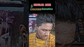 NODULAR ACNE song shortsyoutube viraldisease viralshort [upl. by Krenn]