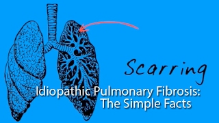 Idiopathic Pulmonary Fibrosis The Simple Facts [upl. by Odrude]