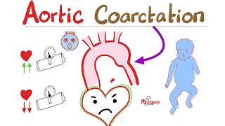 Coarctation of the Aorta  Cardiology Series  Types Symptoms Signs Diagnosis amp Treatment [upl. by Enybor105]