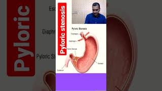 pyloric stenosis to watch full video click on link given in comments section [upl. by Sauncho]