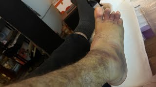 My midfoot and lisfranc injury [upl. by Leik]