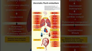 Amniotic fluid embolism [upl. by Airdnal767]