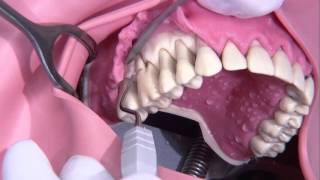 Periodontal surgery Modified Widmann flap [upl. by Penni]