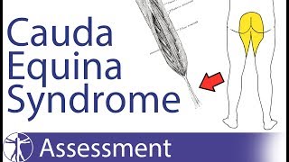 Cauda Equina Syndrome  Signs amp Symptoms [upl. by Lemaceon]