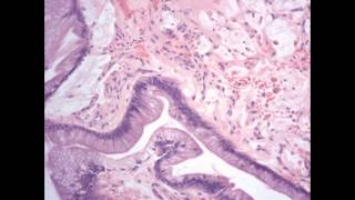 Histopathology Bladder Acquired Nonneoplastic Lesions Cystitis glandularis intestinal type [upl. by Ozzie]