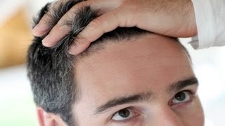 Good Candidates for Hair Transplant  Thinning Hair [upl. by Yeldoow]