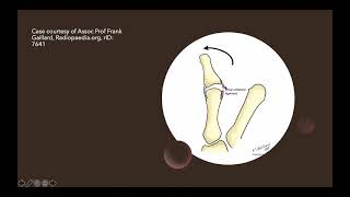 MSK  Trauma  Gamekeepers thumb [upl. by Howard]