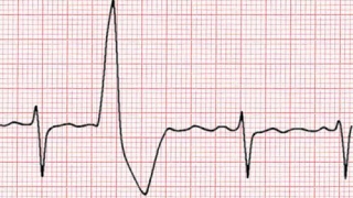 How To Deal With Ectopic Heart Beats PACs amp PVCs [upl. by Bank]